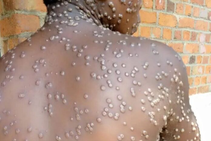 Ghana décès lié virus mpox