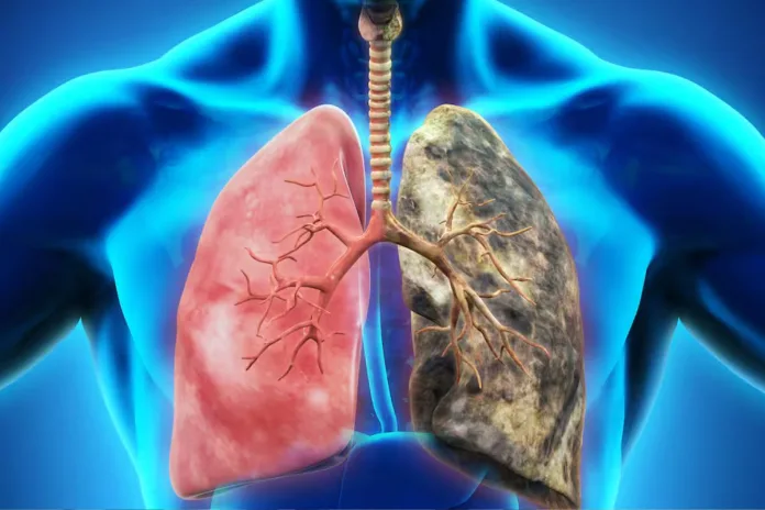 Cancer du poumon pollution non-fumeurs