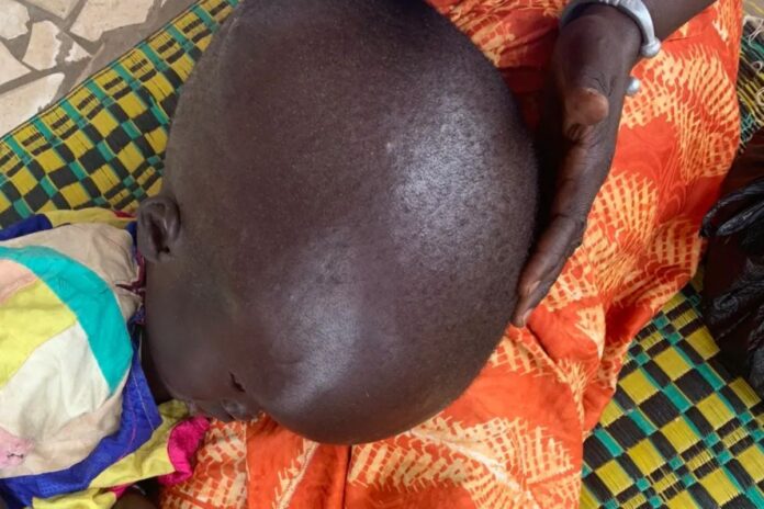 Le Tchad lance un programme de diagnostic de l’hydrocéphalie