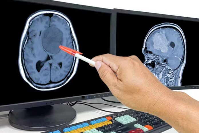 États-Unis tumeur cérébrale jeunes