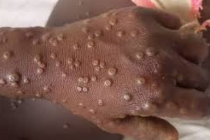 Sénégal : un deuxième cas de Mpox confirmé à Dakar