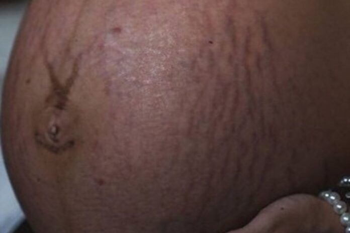 Corps féminin, vergetures ventre femme afrique