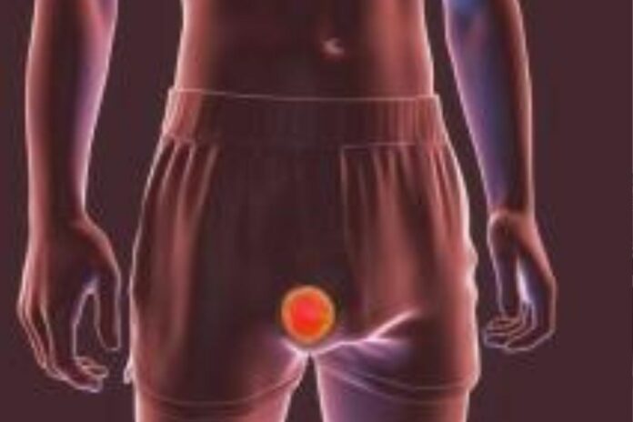 Cancer du testicule : un enjeu majeur de santé chez les jeunes hommes