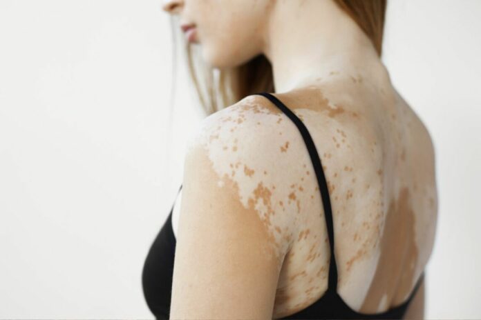 Chine, vitiligo, mari