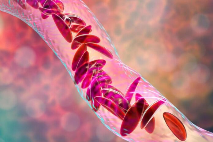 Sénégal : tout va changer pour les malades de la drépanocytose