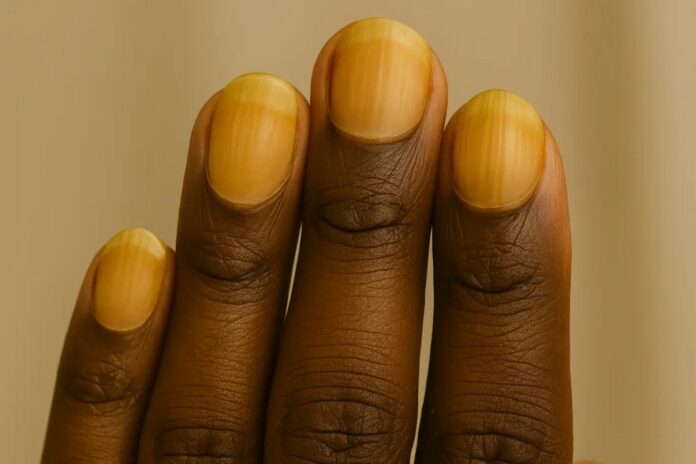 Santé : si vos ongles prennent cette couleur, consultez un médecin